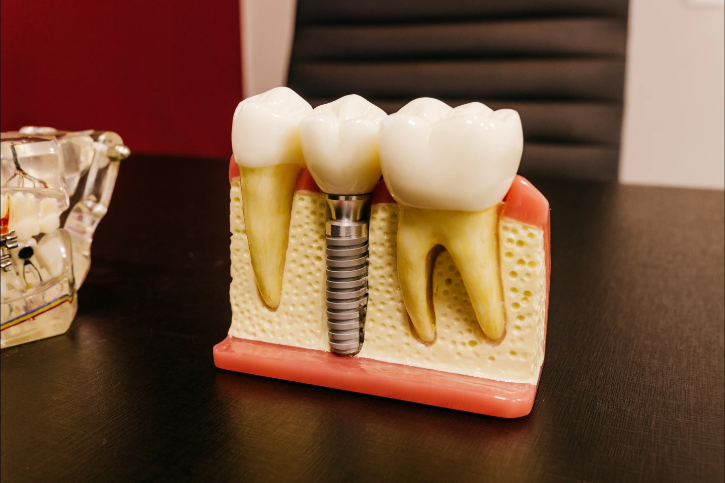 Dental implant model between natural teeth showing strength and bone integration comparison.