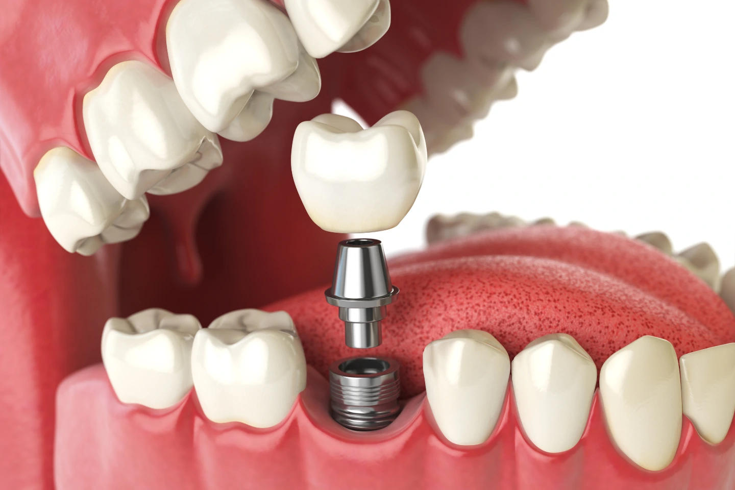 Single Tooth Dental Implants
