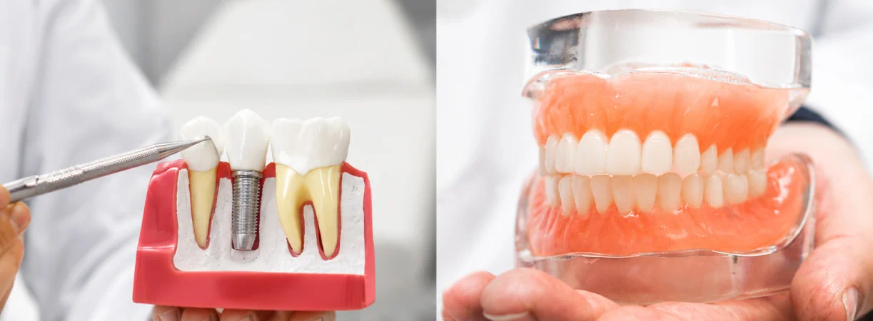 Dental Implants vs Dentures