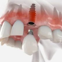 Are Dental implant worth the money, a comparison with other options