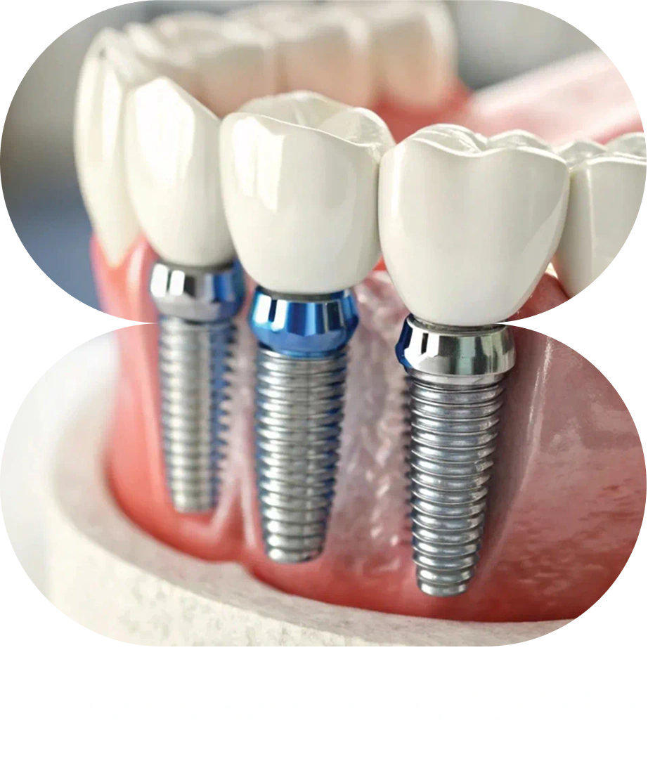 Dental implant and restorative treatments for missing or damaged teeth