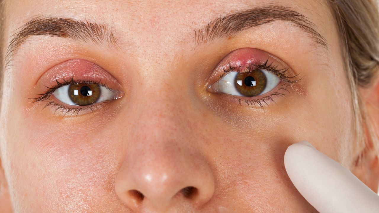 Eyelid Stye Examination By Specialist