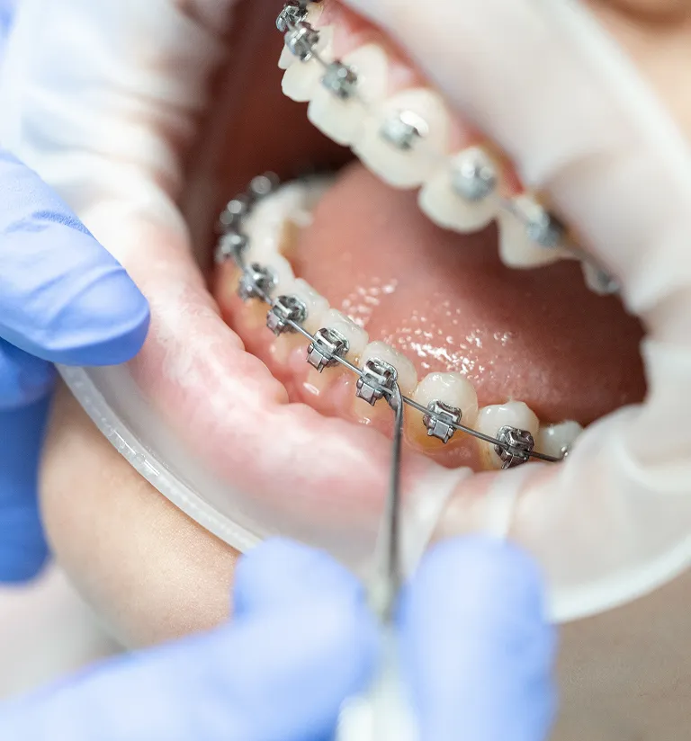 common-braces-problems-southbridge