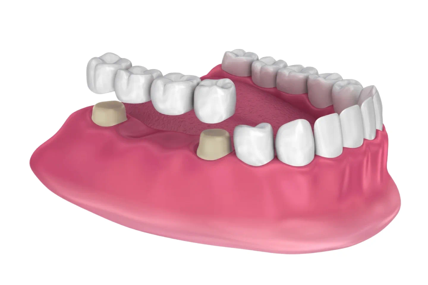 Dental Bridges