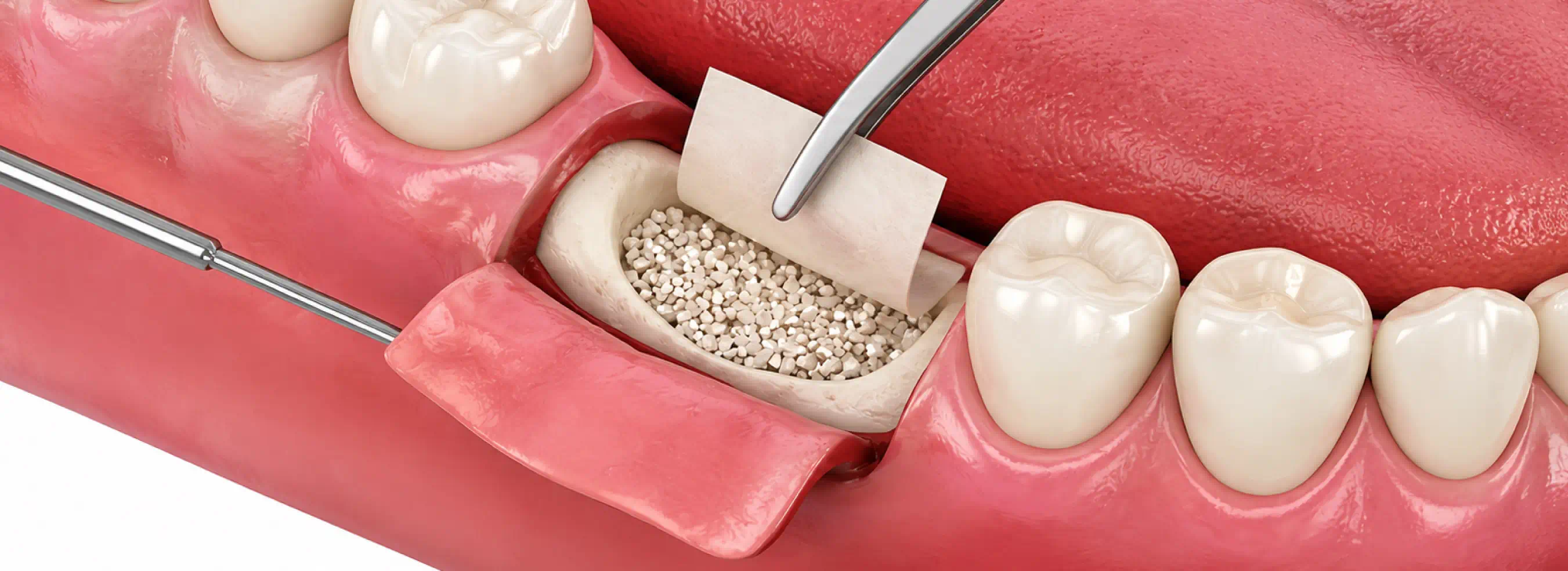 Bone Grafting