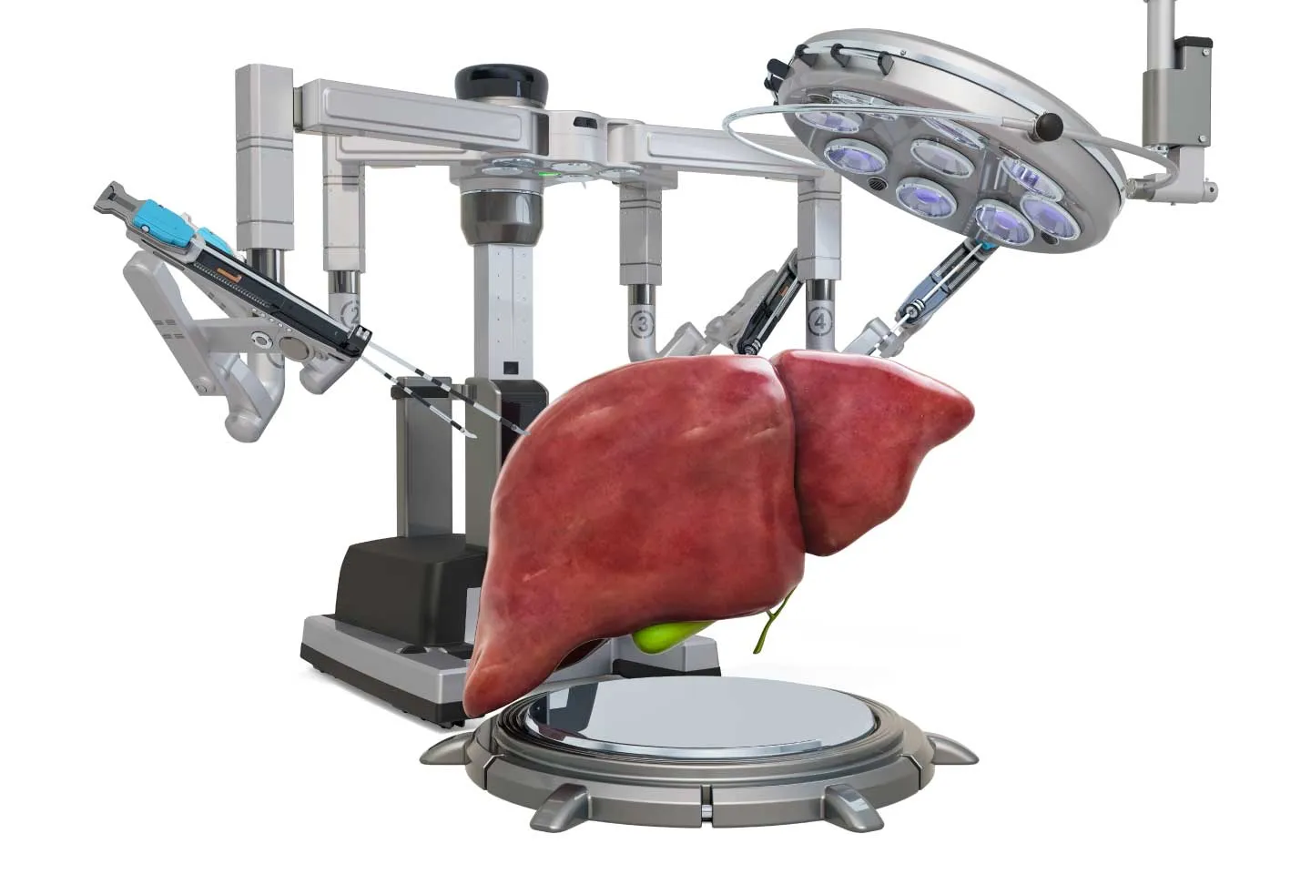 What Are the Advantages of Robotic Gallbladder Surgery Over Laparoscopic Surgery?