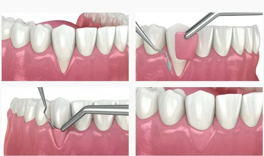 Soft Tissue Grafting