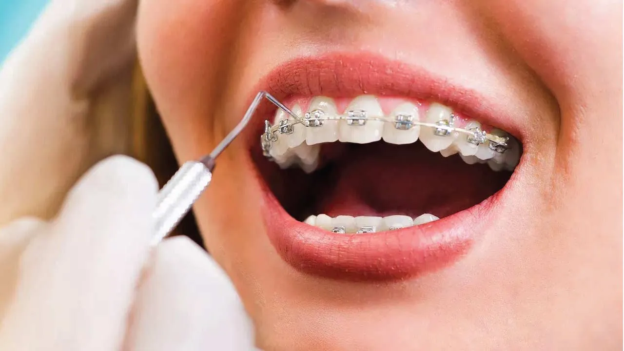 braces care orthodontic illustration