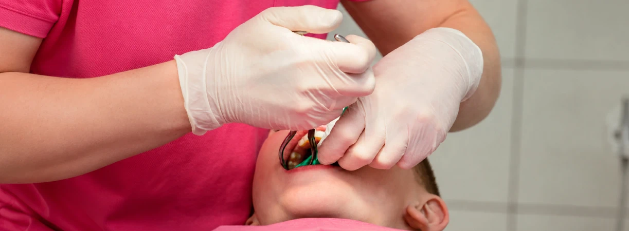 Pulpotomies (Baby root canal)