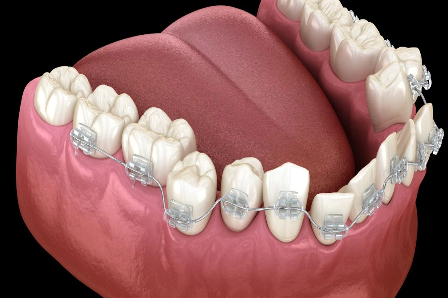 Why You Cant Risk Ignoring Crooked Teeth