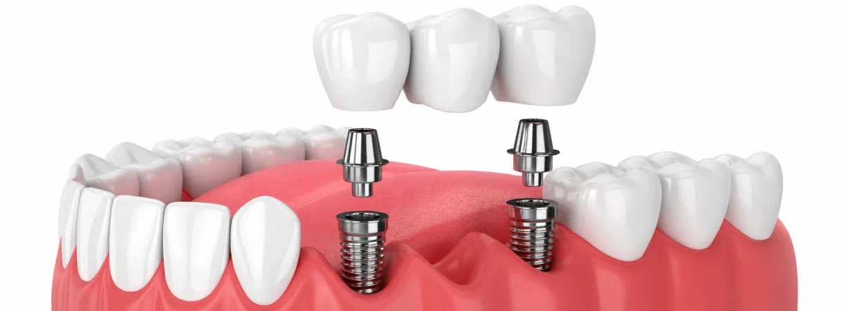 Why More Adults Are Choosing Dental Implants Over Traditional Bridges