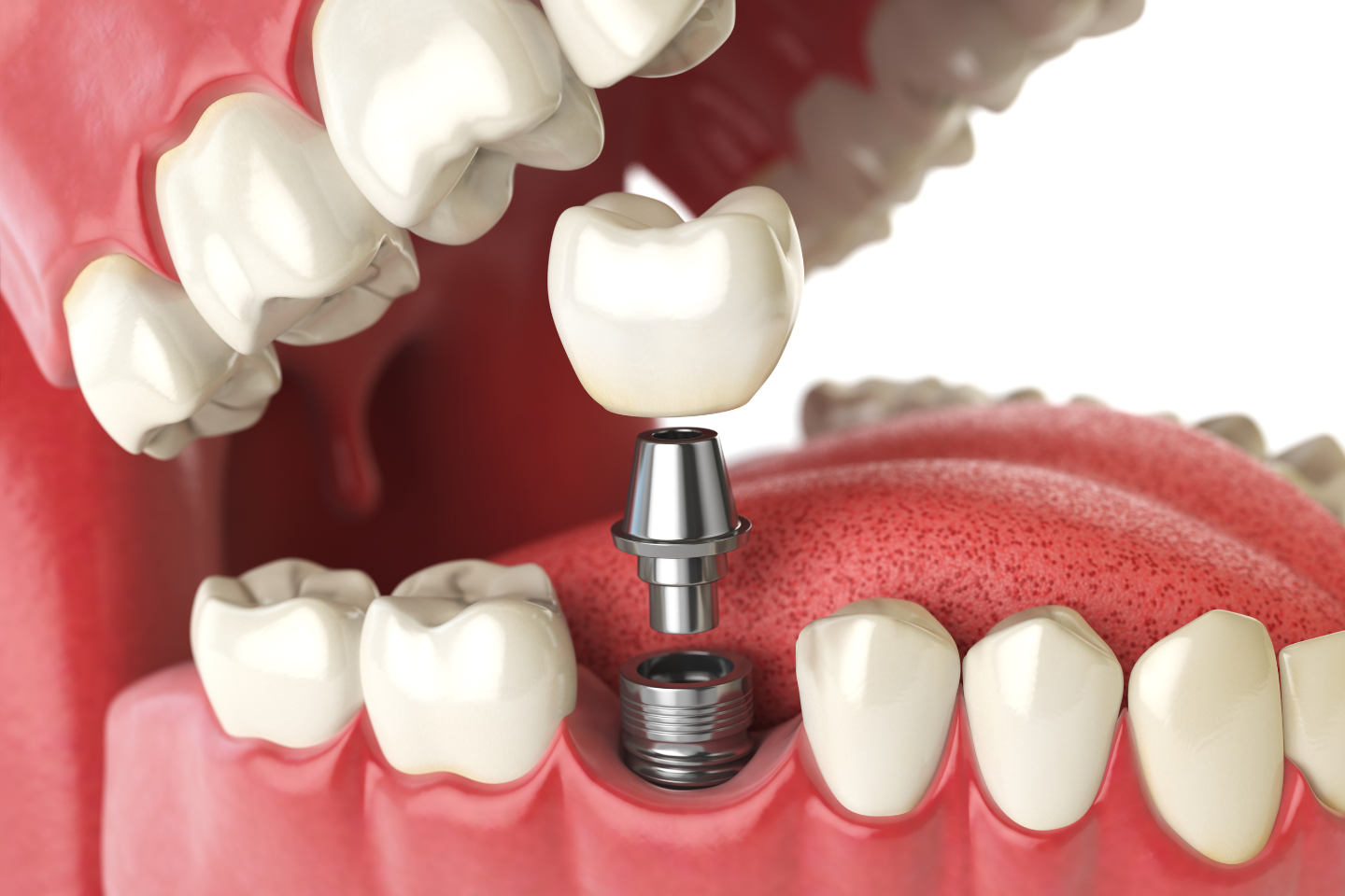 Dental Implants and Bridges