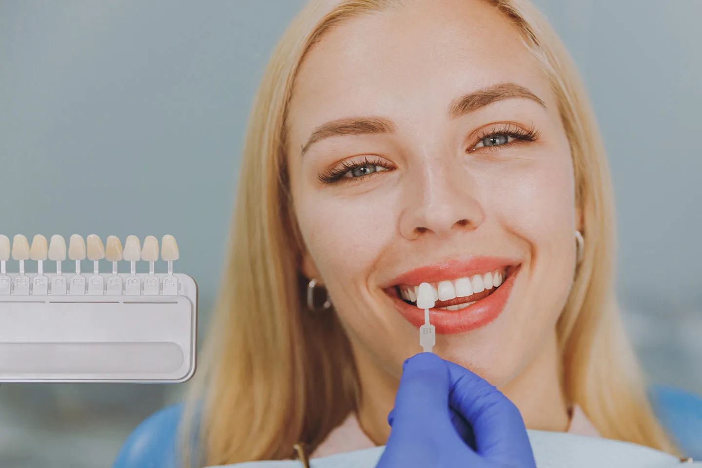 Veneers