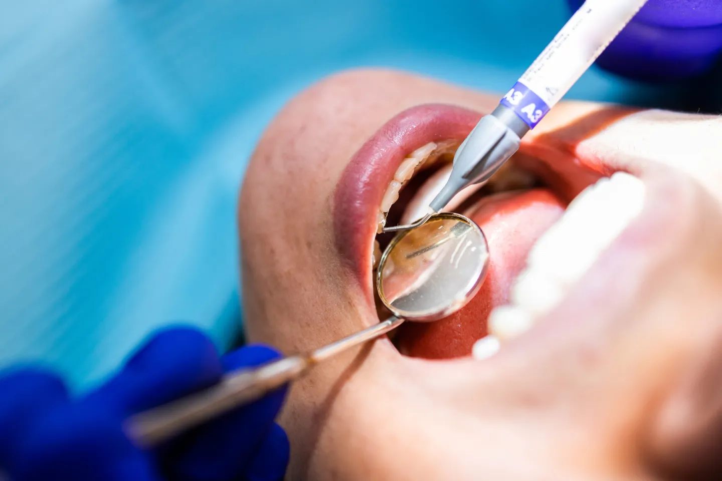 Oral Surgery - Rockville Family Dental