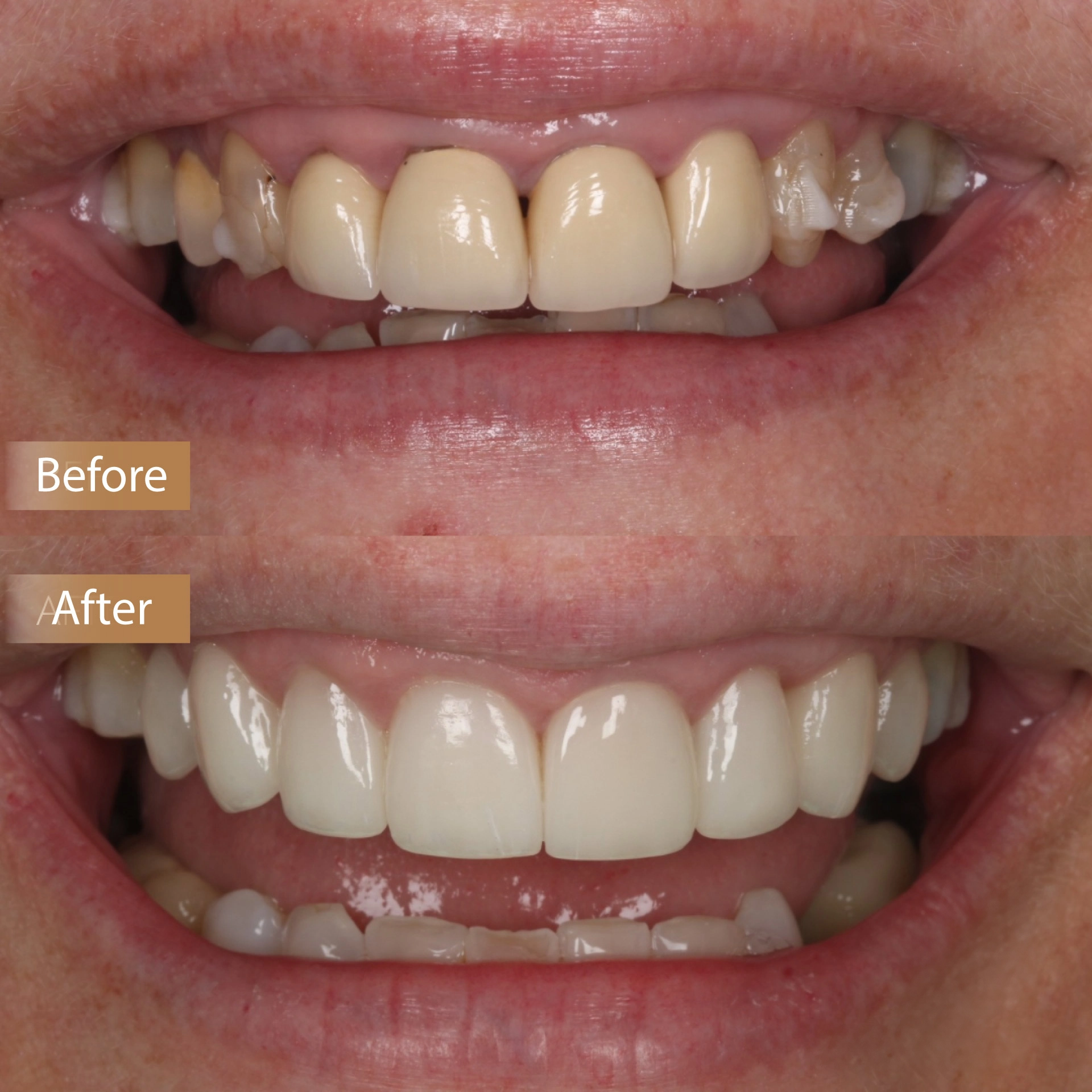 Smile Makeover image