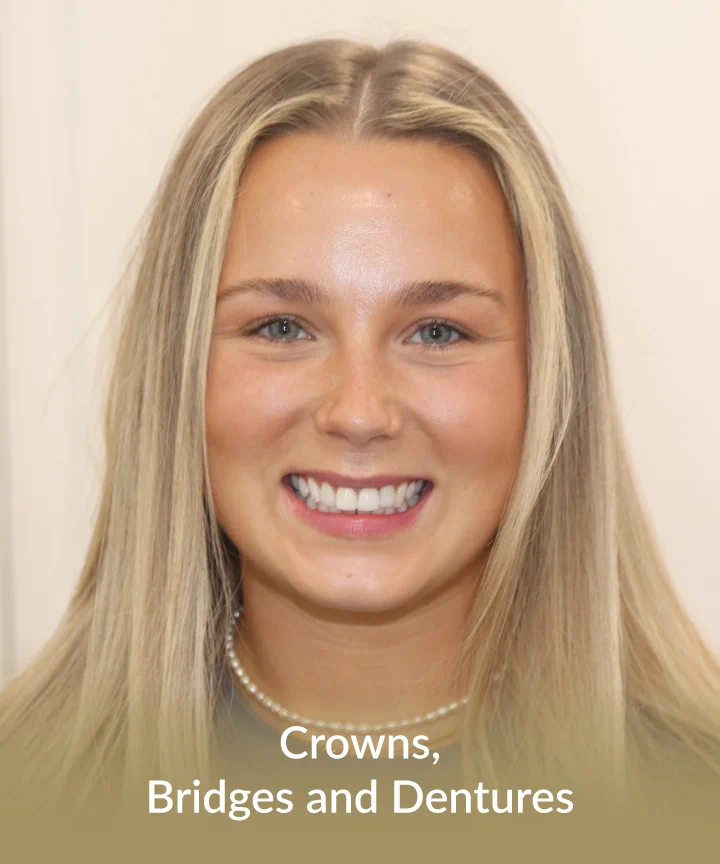 Crowns, bridges