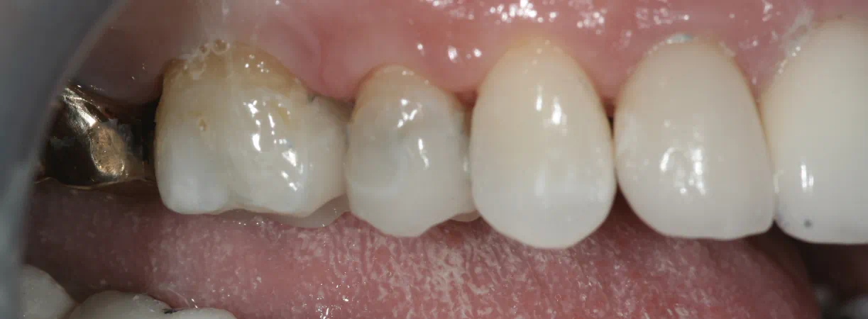 Cerec
