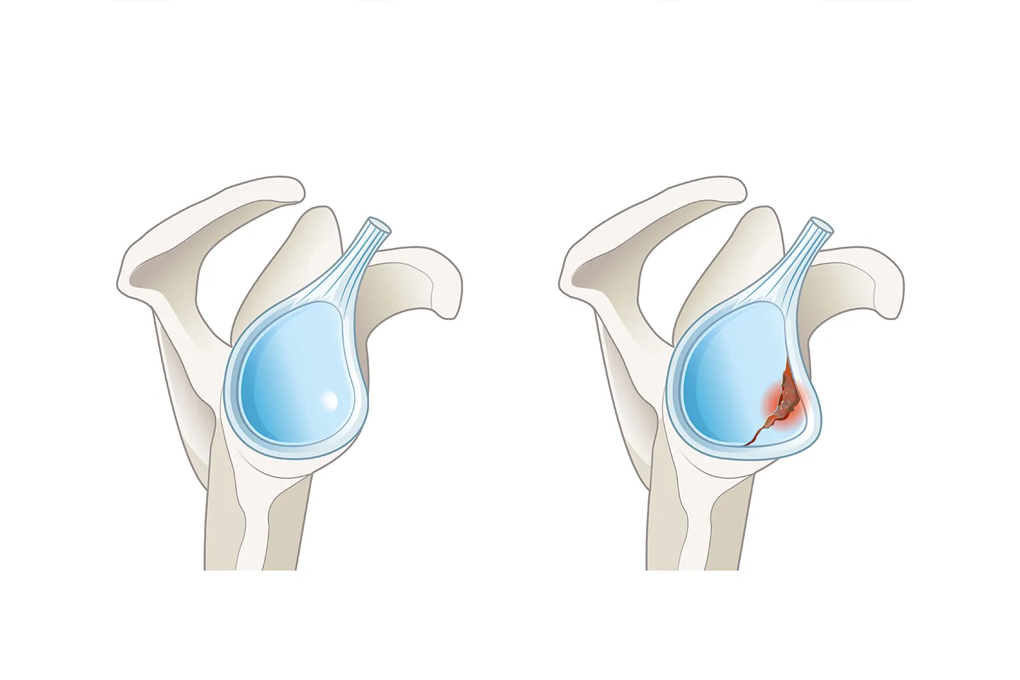 Labral Repair Rehabilitation (Hip, Shoulder)