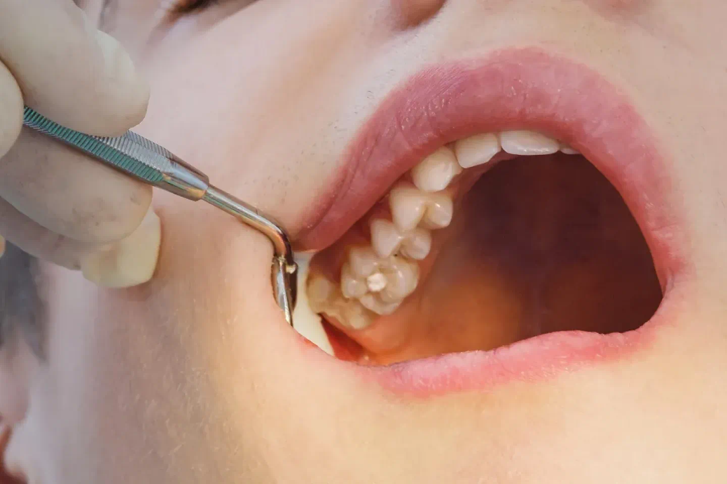 Fillings