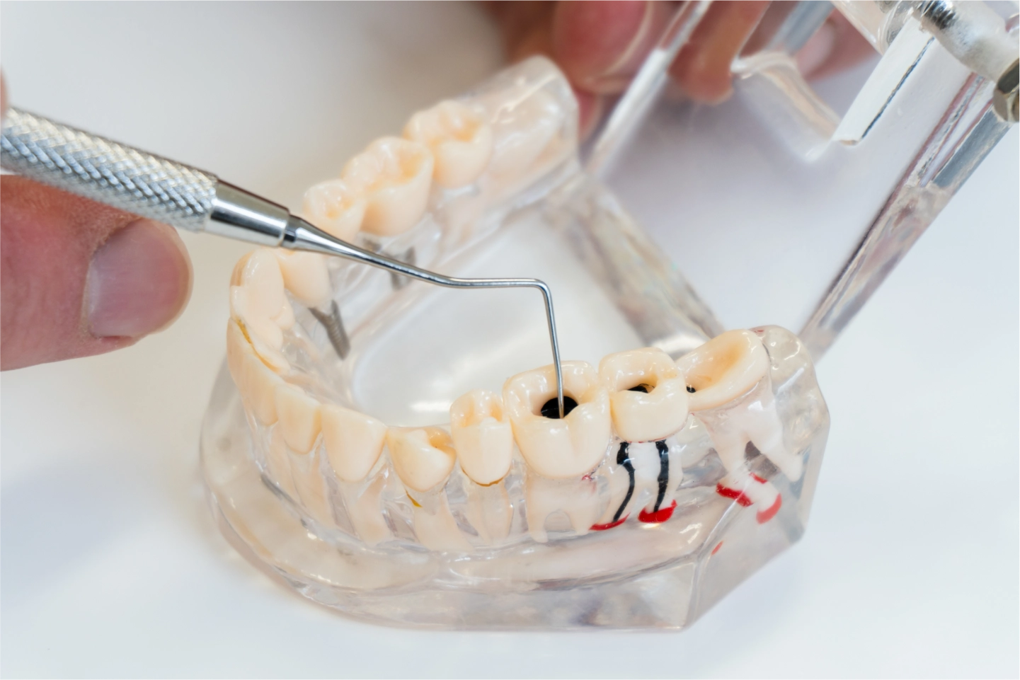 Root Canal Therapy: Saving Your Teeth from Extraction | Expert Guide