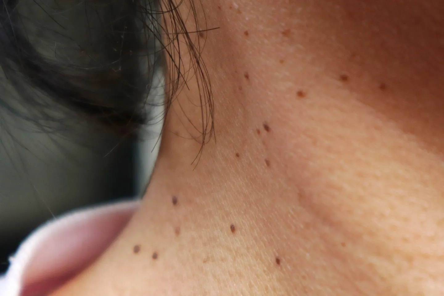 Many black seborrheic keratoses on side neck which grow more as they get older 