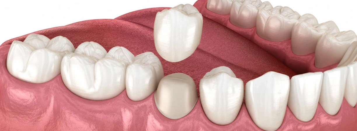 Dental Crowns