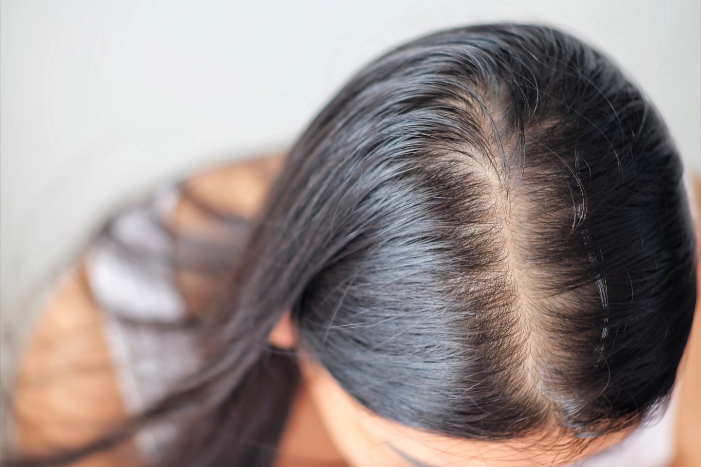 Get Hair Loss Restoration at Lily Aesthetics in Parker, CO
