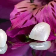 How are Veneers Done?