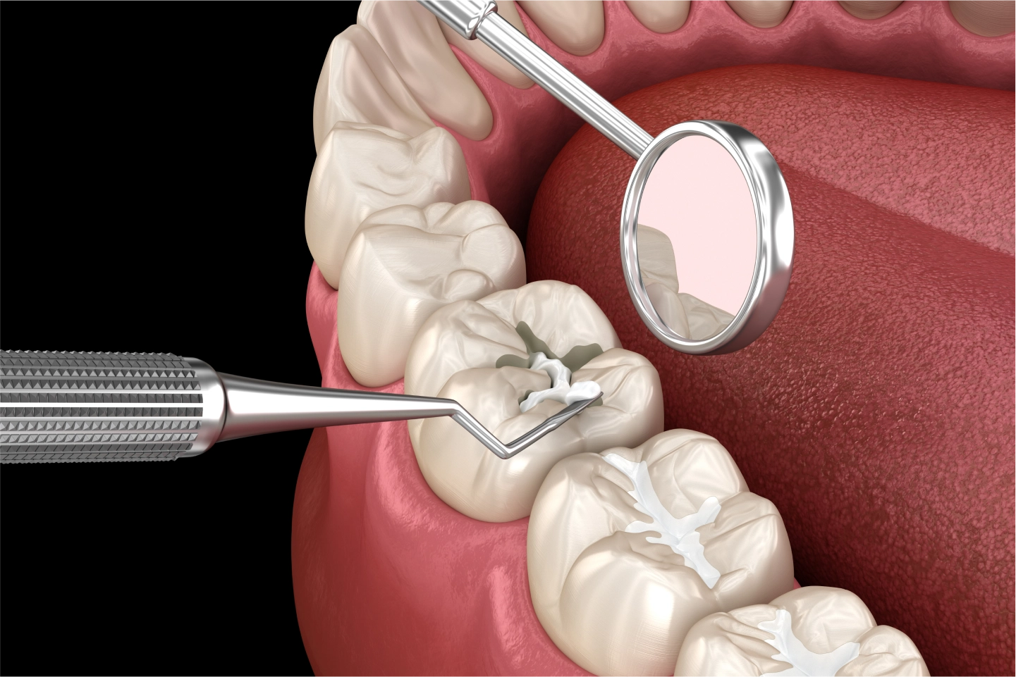 Dental sealant