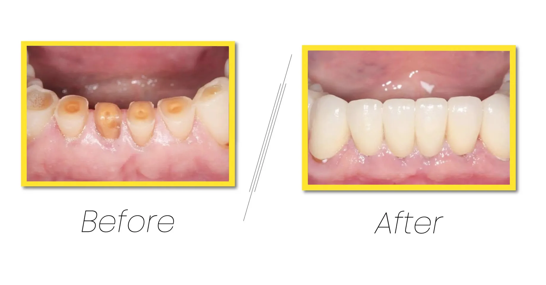 Dental Veneers transform smiles with thin porcelain shells