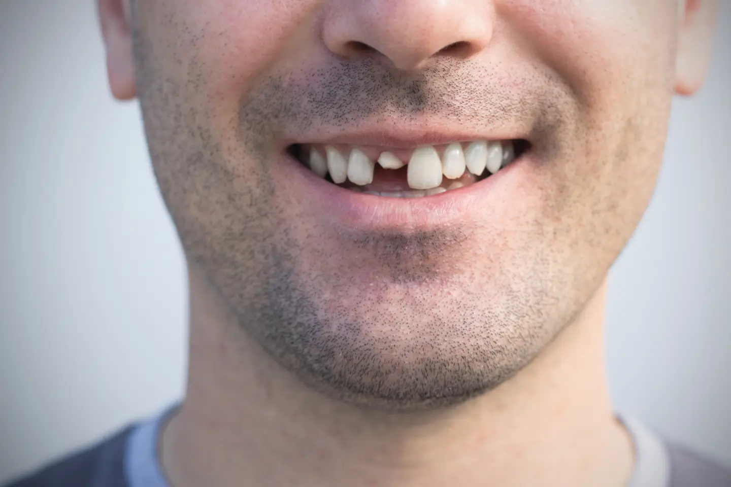Ignoring a Cracked Tooth? Here’s Why It Can Be Dangerous