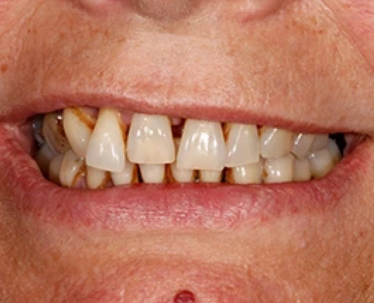 Implants case 3
