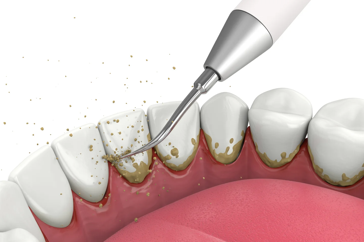Dental Implants