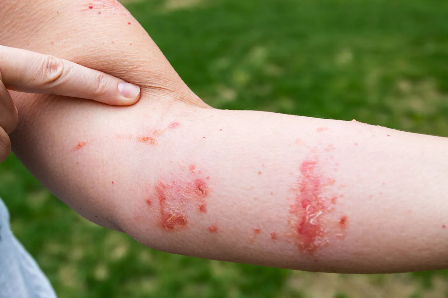 The allergic reaction causes a rash followed by bumps and blisters that itch