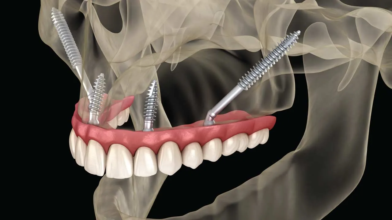 zygomatic implant dental surgery diagram