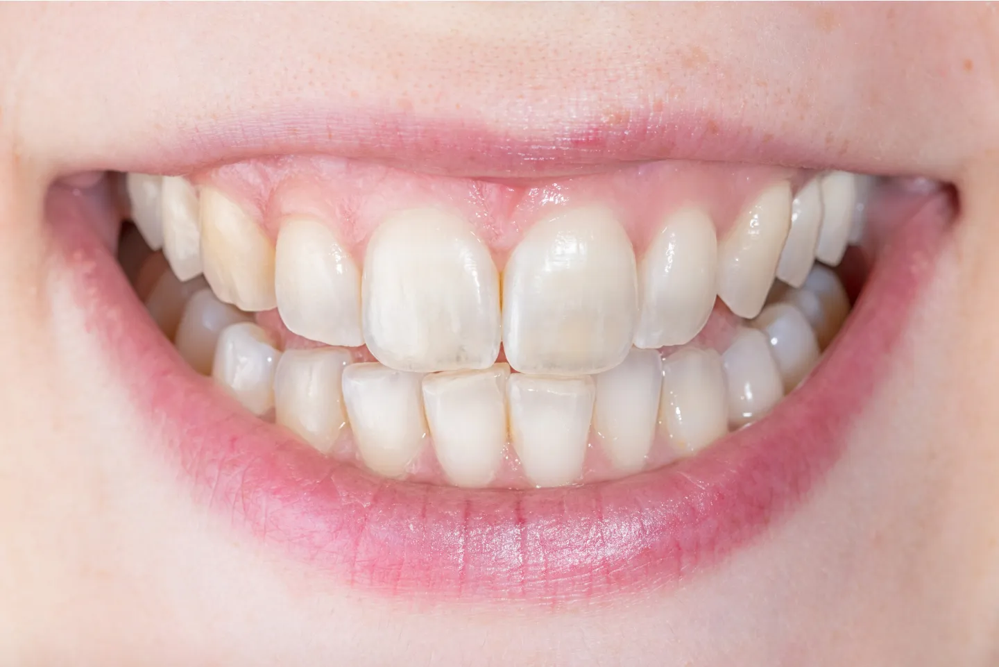 Professional teeth whitening treatments at Glendale Heights Family Dental