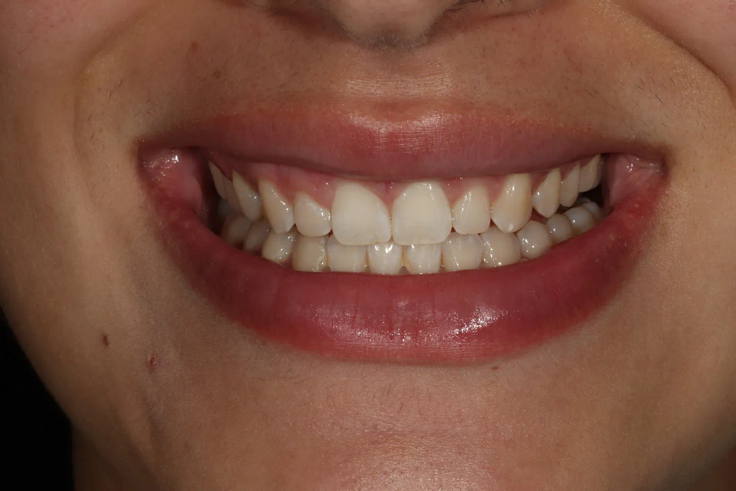 Teeth Straightening