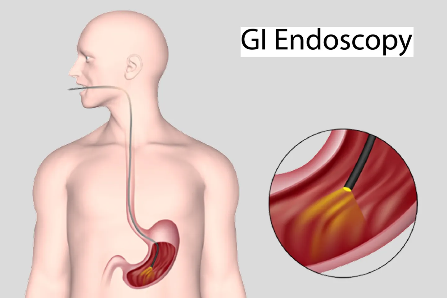 GI Endoscopy