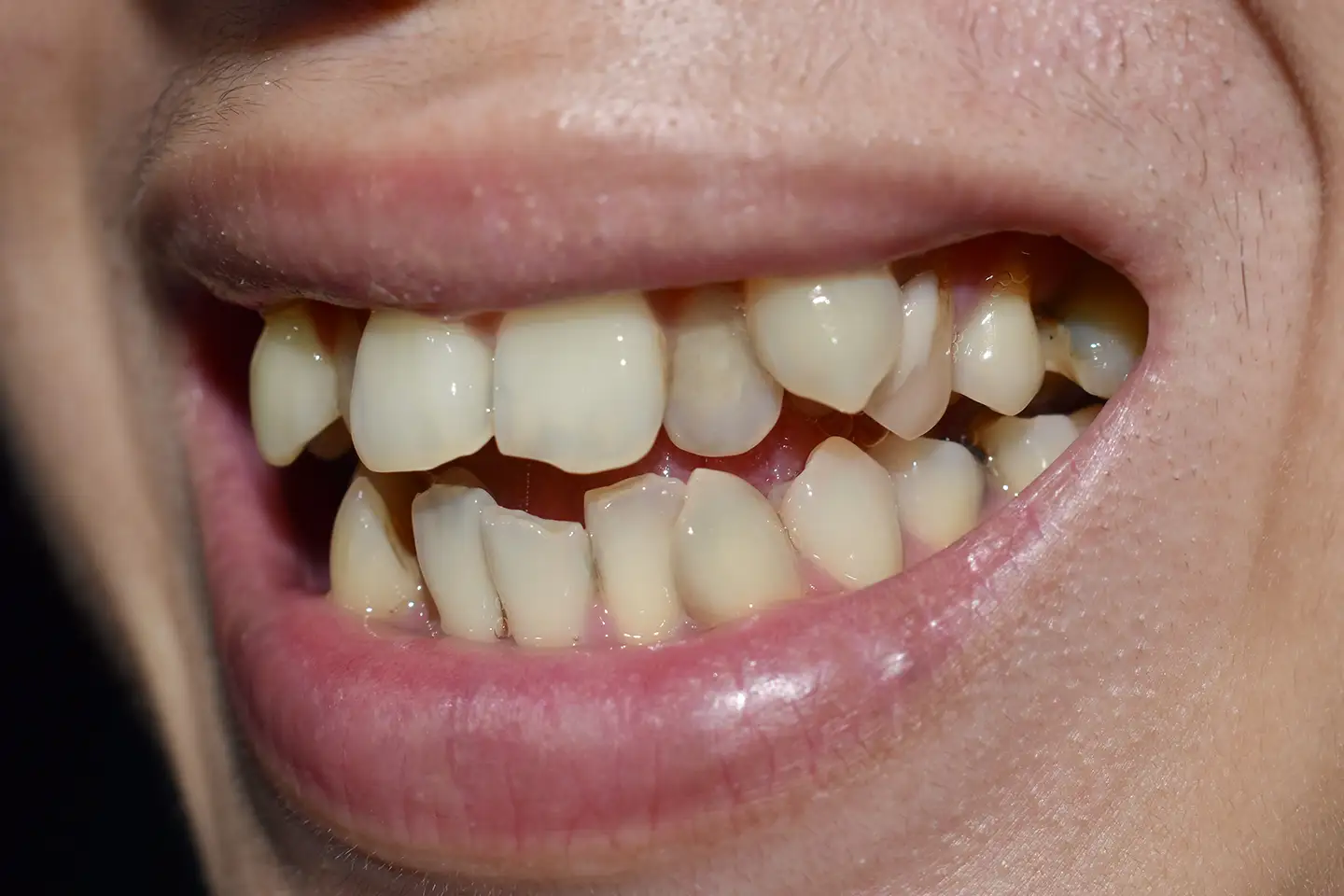 Impacted Tooth: Symptoms And Complications