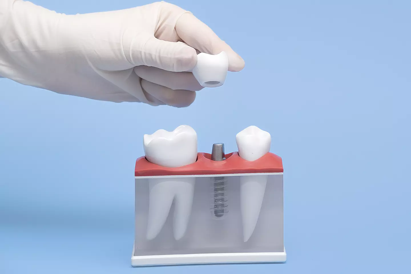 Dental Implants and Implant Restorations