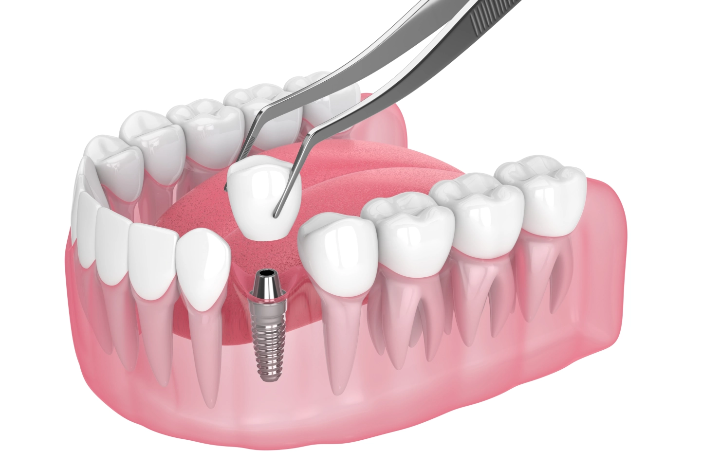 Dental Implant Candidate - Rockville Family Dental