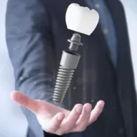Implant Denture Vs All On Four – A Detailed Look