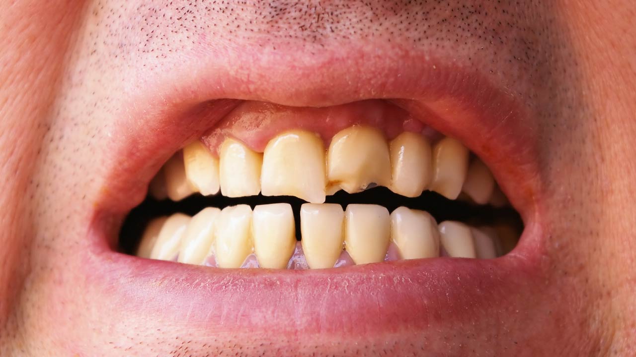 Cracked Tooth Treatment: Symptoms, Causes & How Dentists Help Save Your Tooth