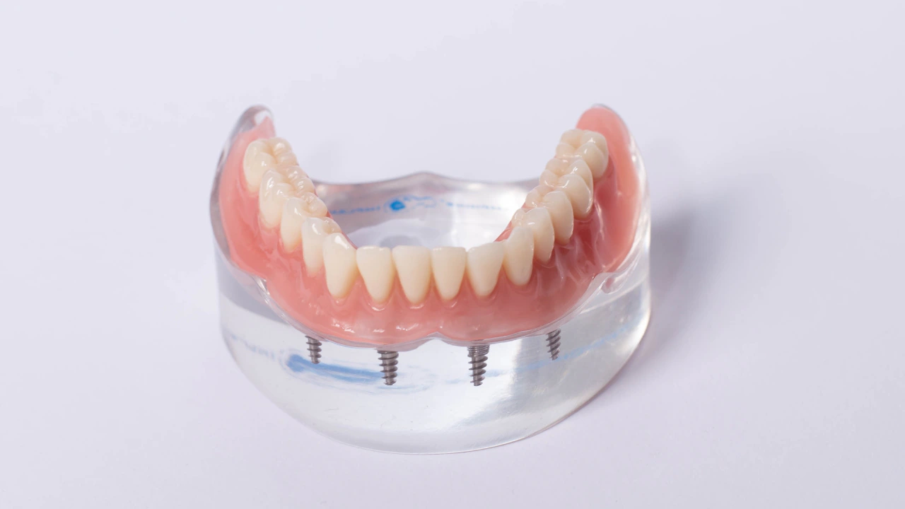 Full-Arch Same-Day Smile | Immediate Smile Restoration