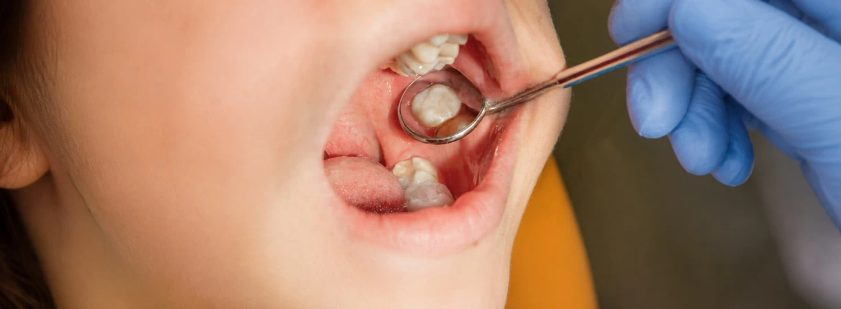 White Fillings