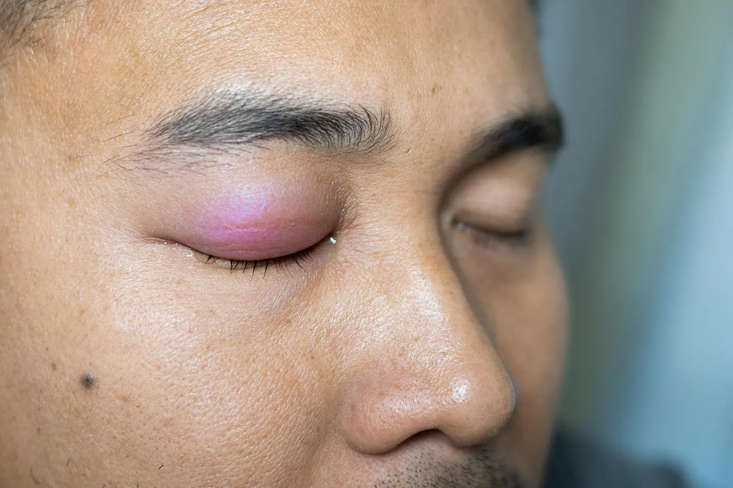 What To Do if a Mosquito Bites Your Eyelid