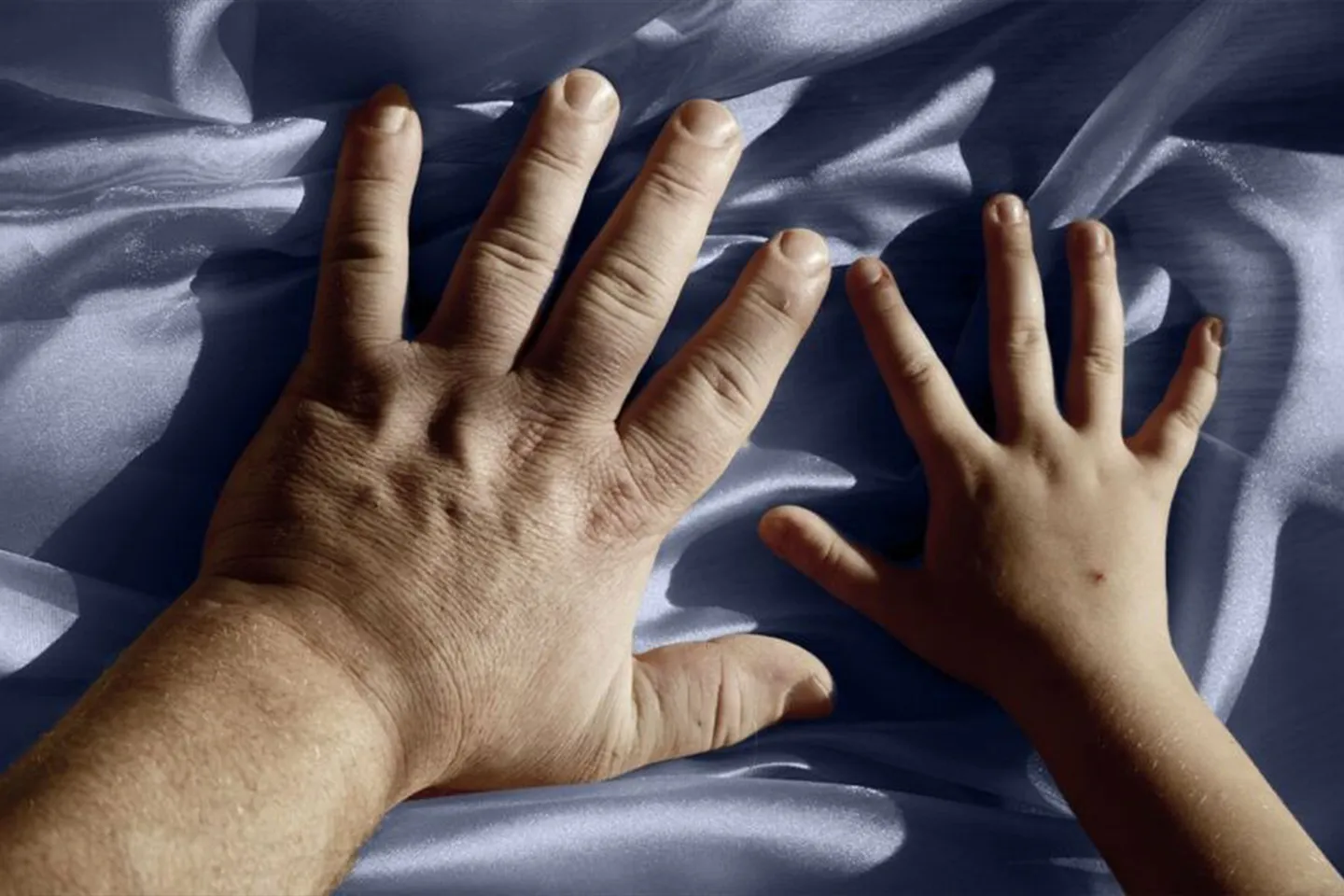 Acromegaly or Gigantism