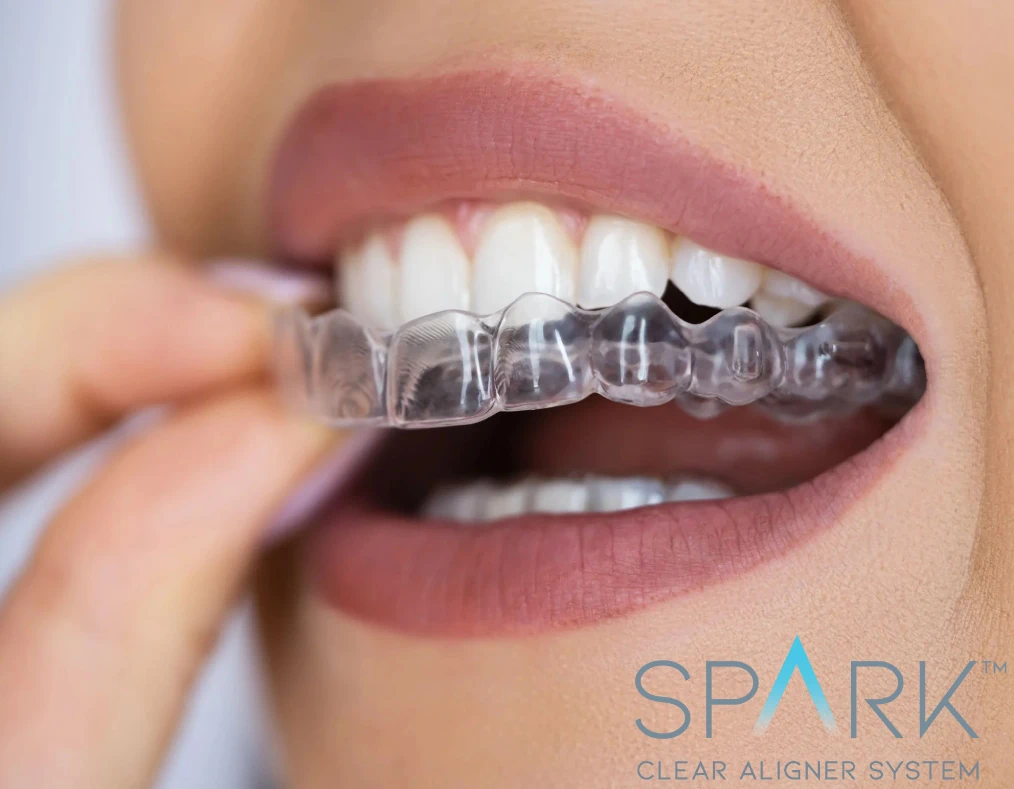 Spark Clear Aligners