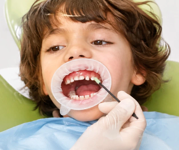 Fluoride treatment