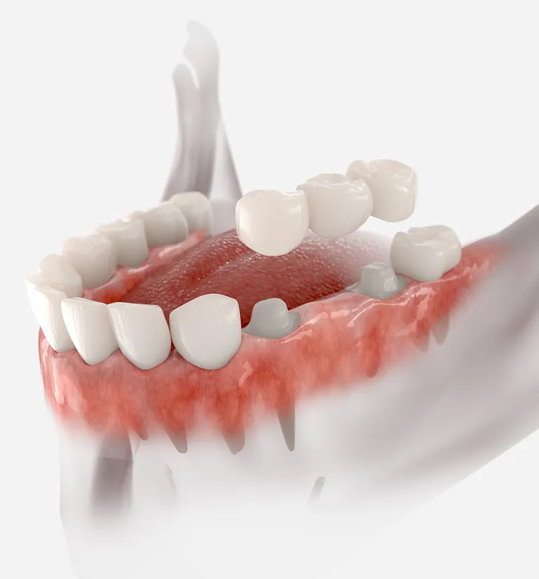 Dental crowns